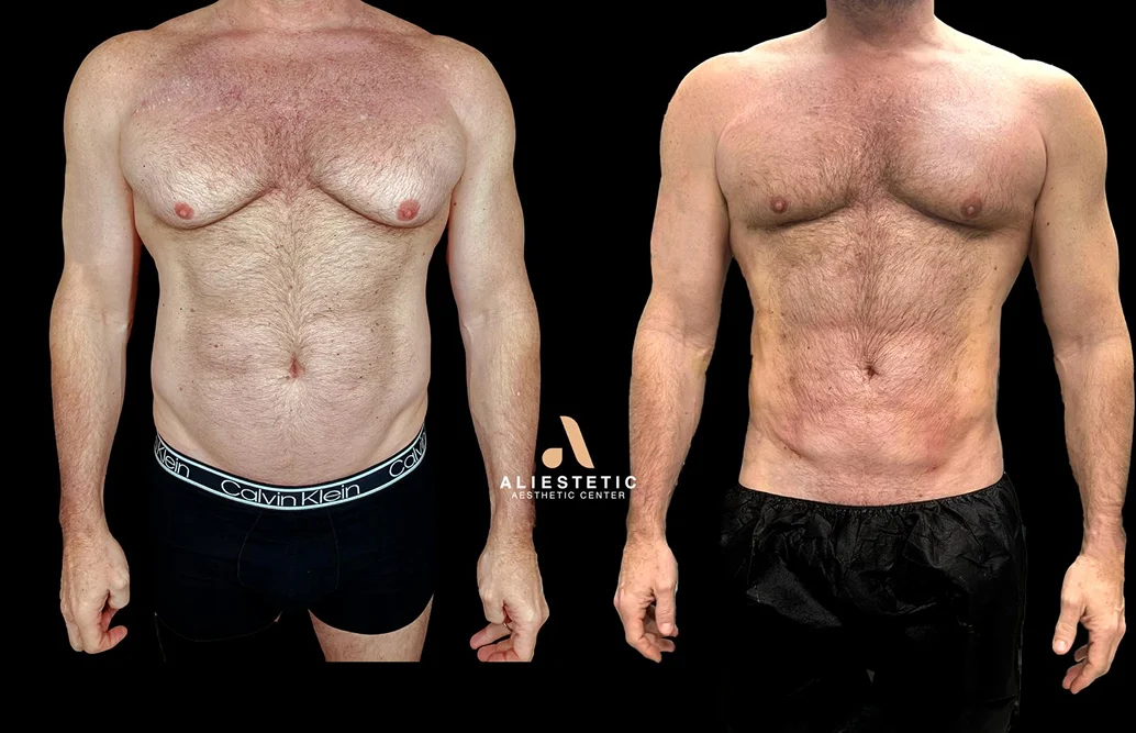 Foto de resultado real de Liposucción, paciente de Aliestetic (4 de 6)