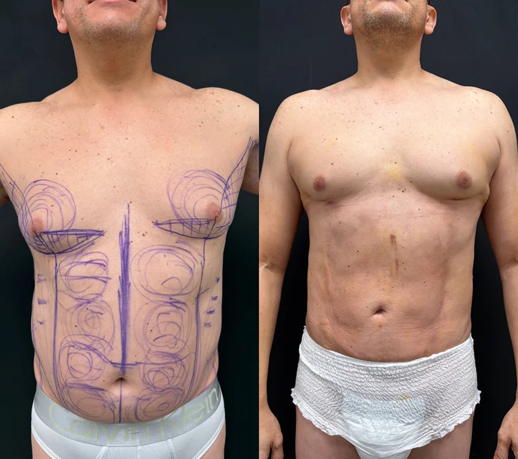 Foto de resultado real de Liposucción, paciente de Aliestetic (2 de 6)