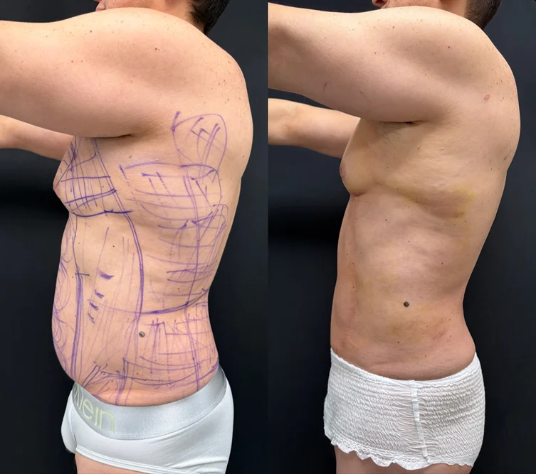 Foto de resultado real de Liposucción, paciente de Aliestetic (3 de 6)