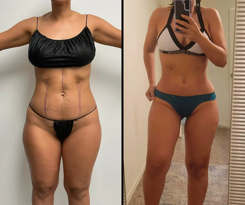 Foto de resultado real de Mommy Makeover, paciente de Aliestetic (3 de 3)