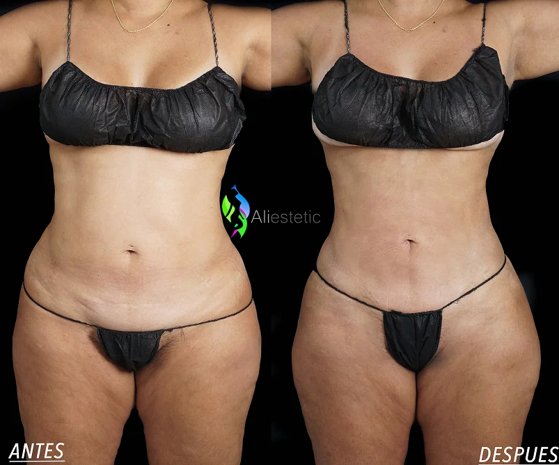 Foto de resultado real de Lipo 360, paciente de Aliestetic (2 de 6)