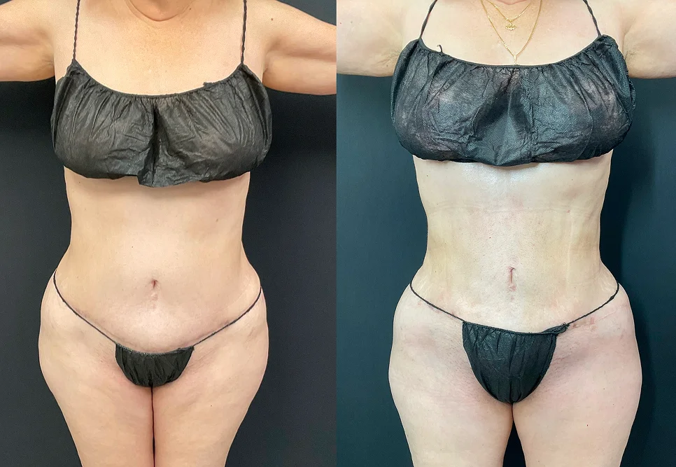 Foto de resultado real de Lipo 360, paciente de Aliestetic (3 de 6)