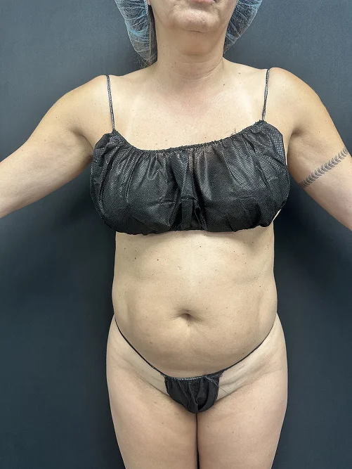 Foto de resultado real de Lipo 360, paciente de Aliestetic (5 de 6)