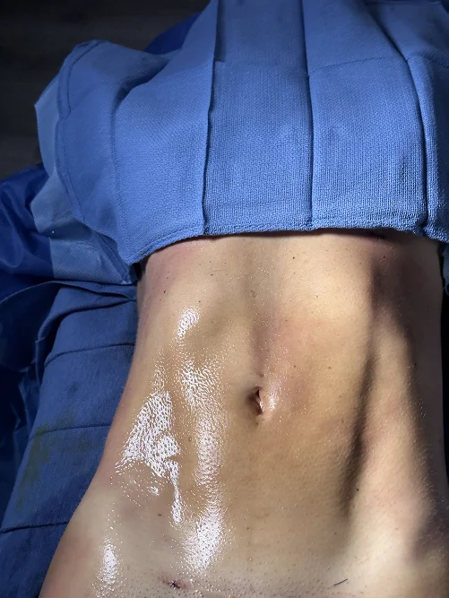 Foto de resultado real de Lipo 360, paciente de Aliestetic (6 de 6)