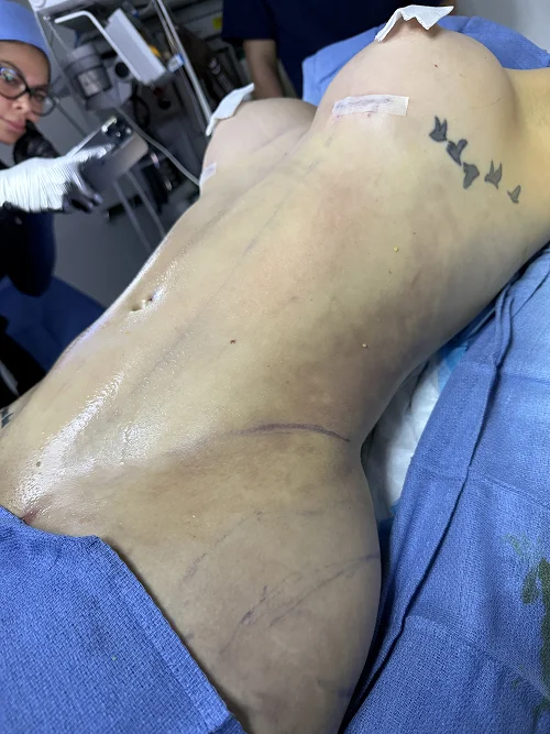 Foto de resultado real de Liposucción, paciente de Aliestetic (5 de 6)