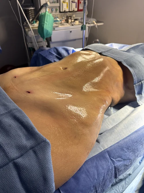 Foto de resultado real de Liposucción, paciente de Aliestetic (6 de 6)