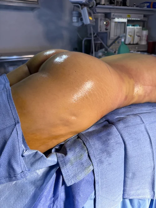 Foto de resultado real de Brazilian Butt Lift, paciente de Aliestetic (4 de 6)