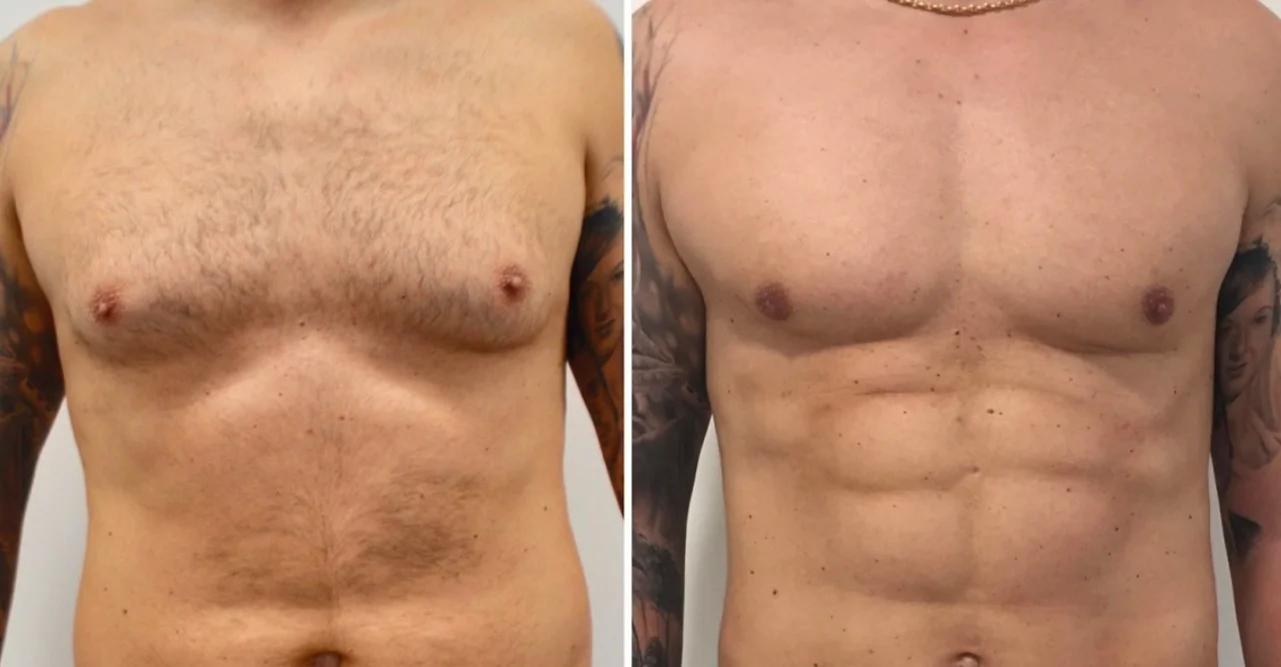 Foto de resultado real de Liposucción, paciente de Aliestetic (1 de 6)