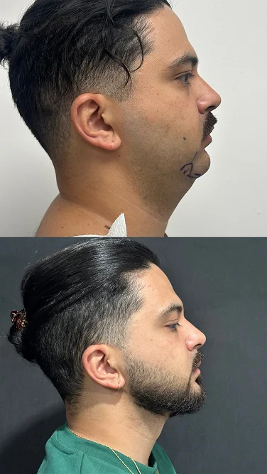 Foto de resultado real de Lipopapada, paciente de Aliestetic (1 de 5)