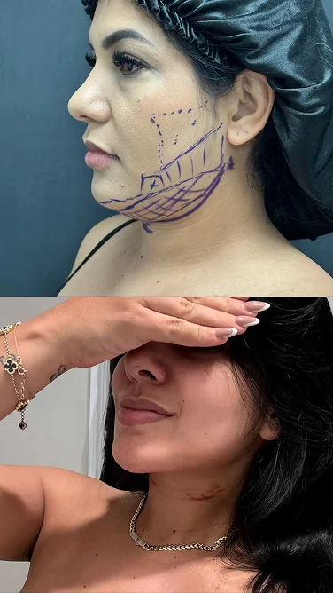 Foto de resultado real de Lipopapada, paciente de Aliestetic (4 de 5)
