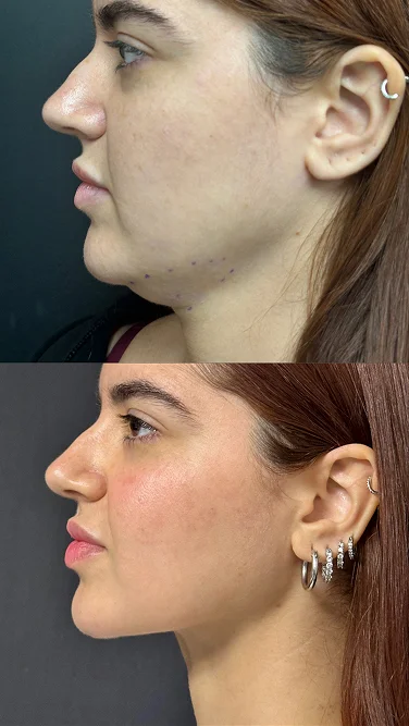 Foto de resultado real de Lipopapada, paciente de Aliestetic (5 de 5)