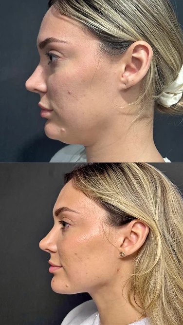 Foto de resultado real de Lipopapada, paciente de Aliestetic (3 de 5)