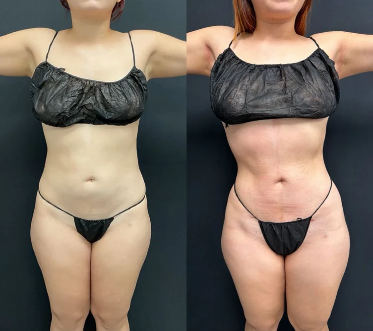 Foto de resultado real de Brazilian Butt Lift, paciente de Aliestetic (2 de 6)