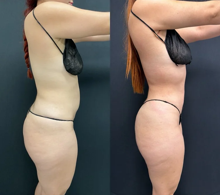 Foto de resultado real de Brazilian Butt Lift, paciente de Aliestetic (1 de 6)
