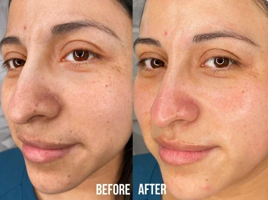 Before and after photo of an Aliestetic patient (9 of 15)