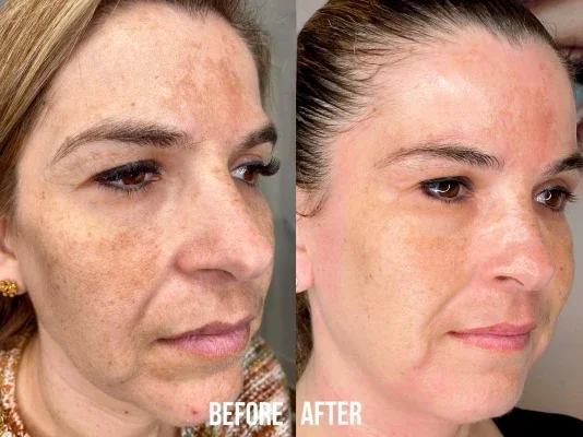 Before and after photo of an Aliestetic patient (10 of 15)