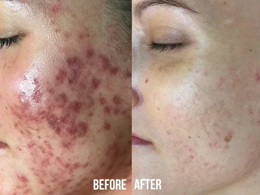 Close-up of a cheek and jaw. Before: numerous inflamed nodules and cysts. After: skin largely free of active lesions, with flat marks and some scarring remaining.