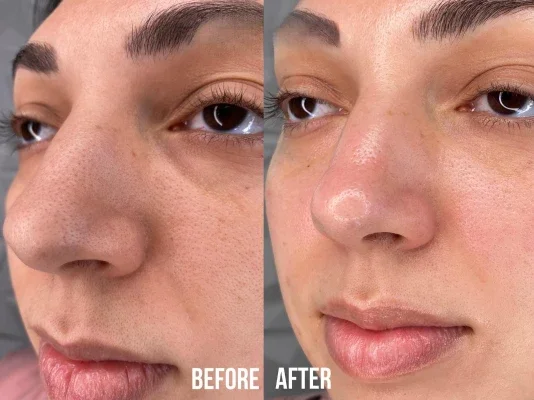 Before and after photo of an Aliestetic patient (12 of 15)