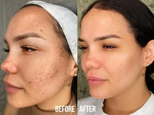 Three-quarter view of a face. Before: active acne lesions and dark post-inflammatory marks across cheek and jaw. After: largely clear with a few residual marks.