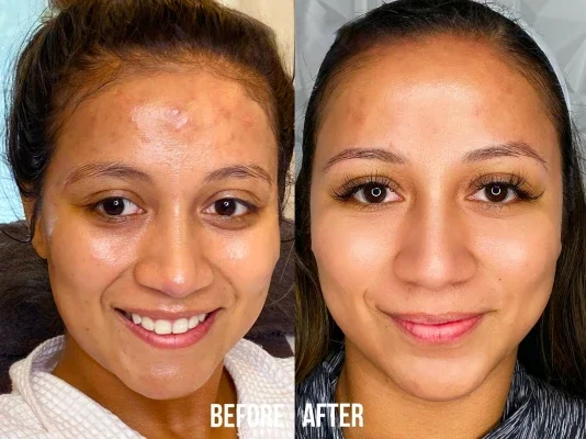 Before and after photo of an Aliestetic patient (14 of 15)