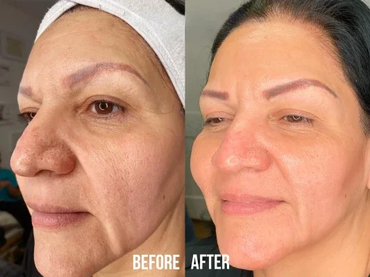 Before and after photo of an Aliestetic patient (15 of 15)