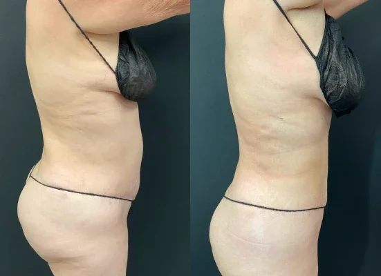 Before and after photo of an Aliestetic patient (1 of 15)