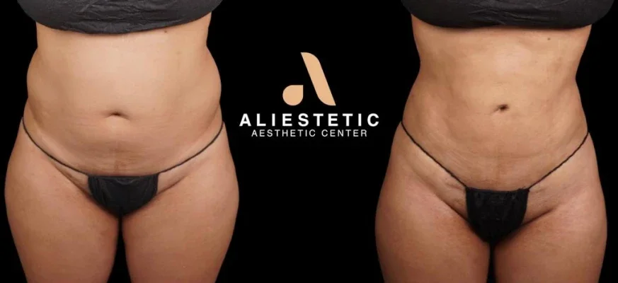Front view of a woman’s midsection. Before: fuller abdomen with a fold above the navel. After: flatter abdomen and a more indented waist.