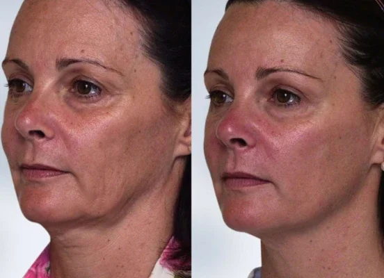 Before and after photo of an Aliestetic patient (3 of 15)