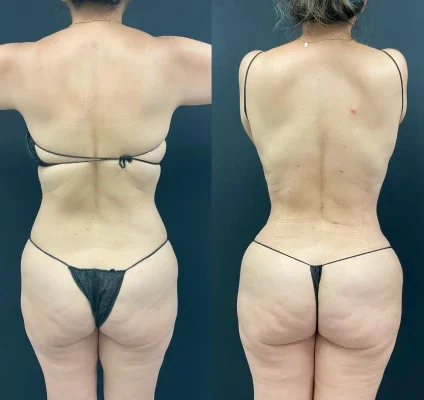 Before and after photo of an Aliestetic patient (4 of 15)
