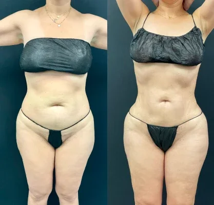 Before and after photo of an Aliestetic patient (5 of 15)