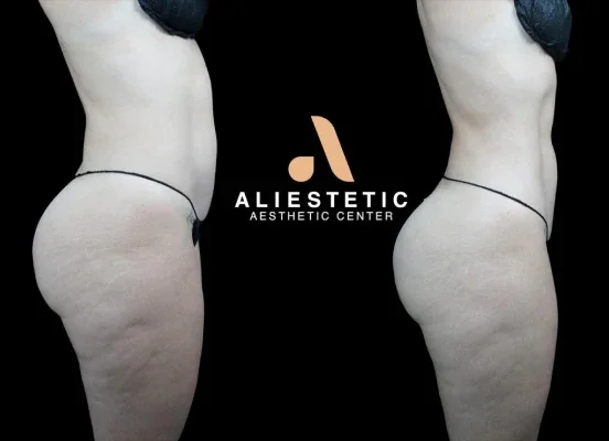 Before and after photo of an Aliestetic patient (6 of 15)