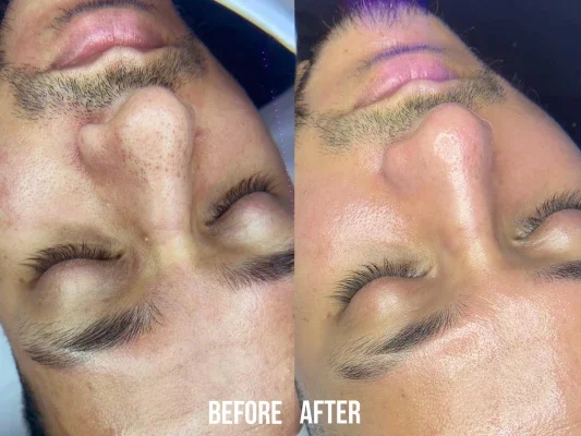 Before and after photo of an Aliestetic patient (7 of 15)
