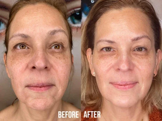 Before and after photo of an Aliestetic patient (8 of 15)